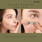 Acne Clearing Pimple Patches (Pack of 2) 144 Patches